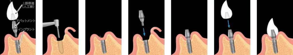 インプラント手術の流れ